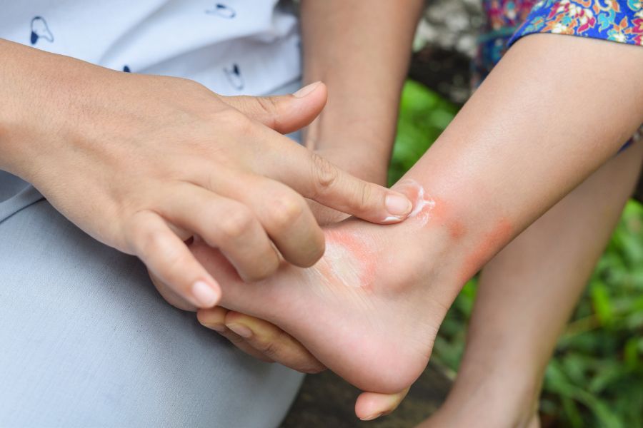 Treating mosquito bites in Aberdeen, NC - Aberdeen Exterminating 